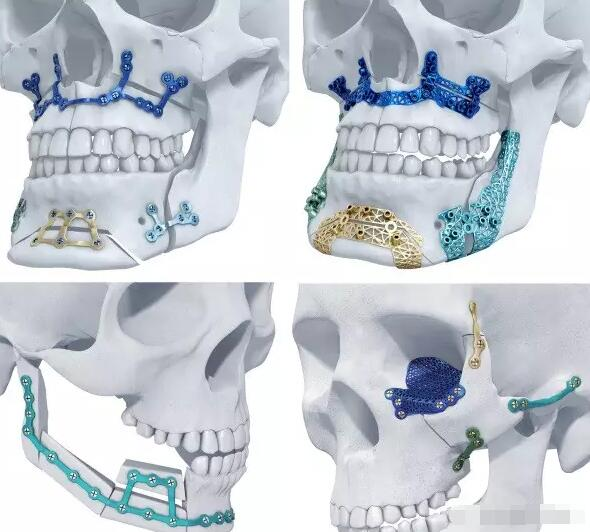 3D 打印新征程：Materialise 與 Feops 的融合創(chuàng)新